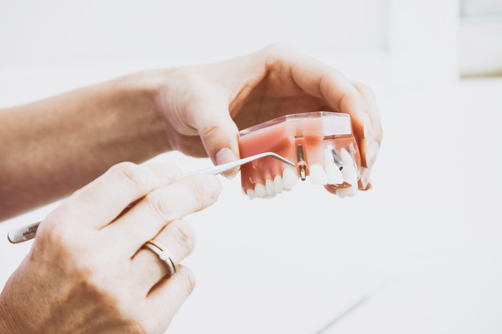 dental-implant-model-dentist